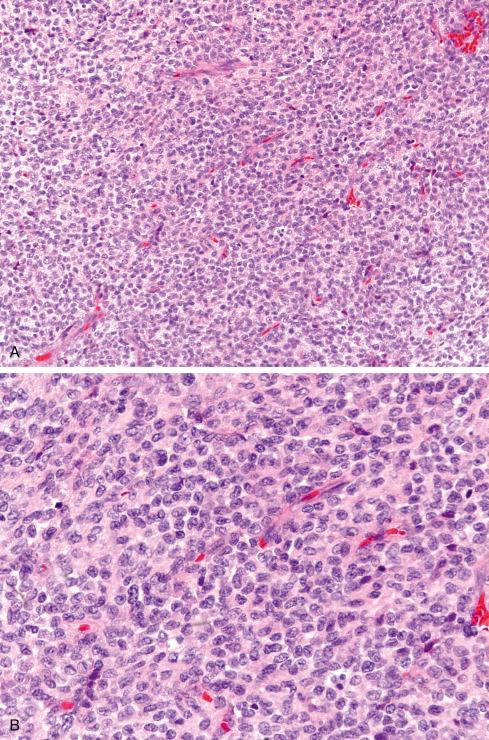 Fig. 25.10, A, Giant cell–poor form of localized TGCT composed exclusively of rounded cells in a richly vascularized background. B, In thick sections, areas such as this can be confused with a malignant round cell tumor.