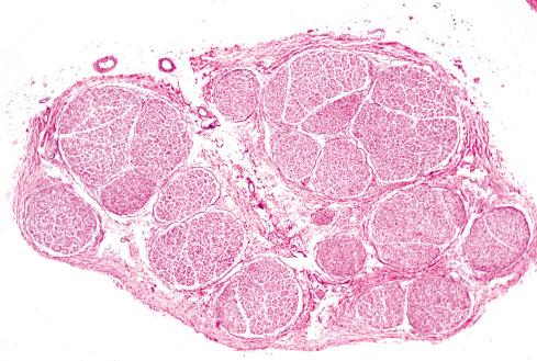 Fig. 26.1, Normal Sciatic Nerve in Cross Section.