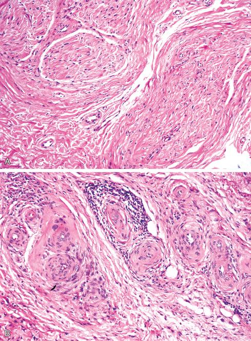 Fig. 26.11, Morton neuroma, characterized by dense perineural ( A ) and perivascular ( B ) fibrosis.