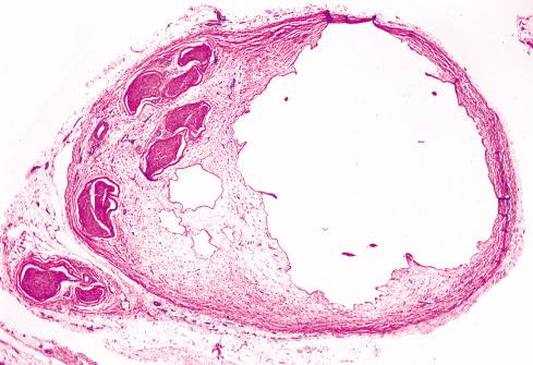 Fig. 26.12, Ganglion of Nerve Sheath.