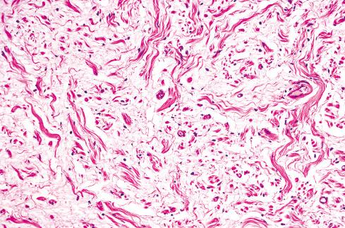 Fig. 26.15, Neurofibroma with myxoid matrix containing neoplastic cells and ropey collagen bundles.