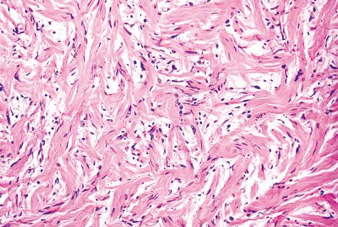 Fig. 26.16, Neurofibroma with dense collagen bundles.