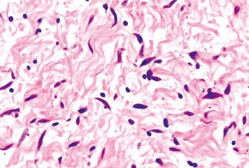 Fig. 26.17, Neurofibroma with Schwann cells of irregular shape, mononuclear cells, and occasional mast cells.