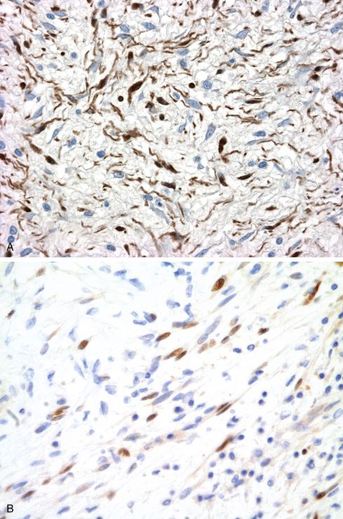 Fig. 26.18, S-100 protein ( A ) and SOX 10 ( B ) immunostains of neurofibroma illustrating that only a subpopulation of cells express the respective antigens. S-100 protein is localized to nucleus and cytoplasm, whereas SOX10 localized to nucleus only.