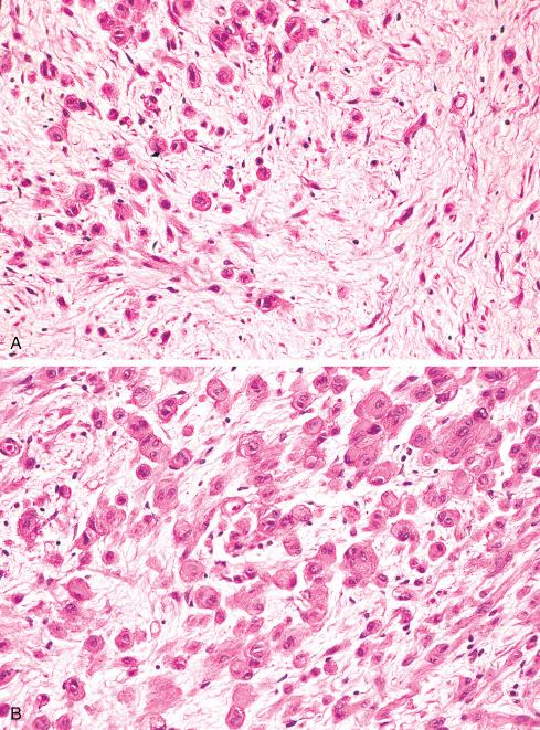 Fig. 26.19, Epithelioid neurofibroma arising in nerve of patient with neurofibromatosis 1 (NF1). A, Transition between epithelioid areas and those with appearance of conventional neurofibroma. B, High-power view of epithelioid areas.