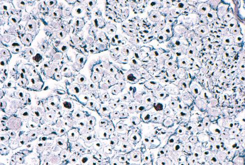 Fig. 26.2, Normal peripheral nerve cut in cross section and stained with Bodian (silver) stain. Individual axons stain positively; surrounding myelin sheath does not stain. The thickness of axons and the myelin sheath varies and determines the conduction speed.