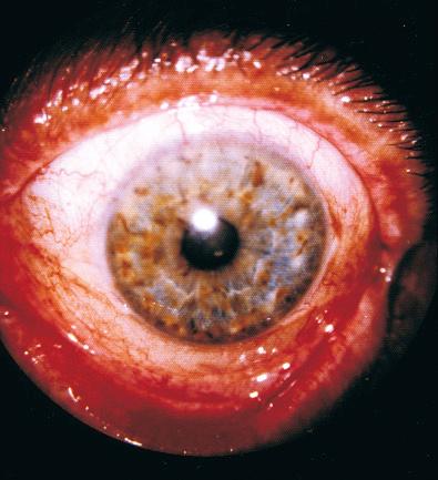 Fig. 26.22, Lisch nodule in patient with NF1. Pigmented areas are seen as brown areas in the iris.