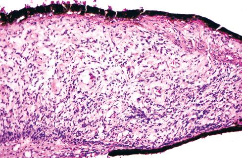 Fig. 26.23, Lisch nodule showing collections of pigment in the iris.