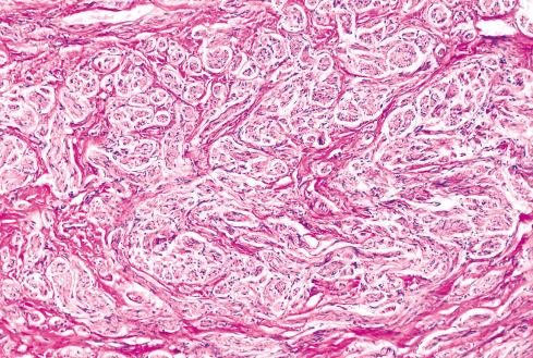 Fig. 26.4, Traumatic neuroma composed of small proliferating fascicles of nerve enveloped in collagen.