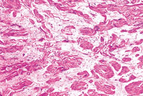 Fig. 26.5, Myxoid areas in traumatic neuroma resembling neurofibroma.