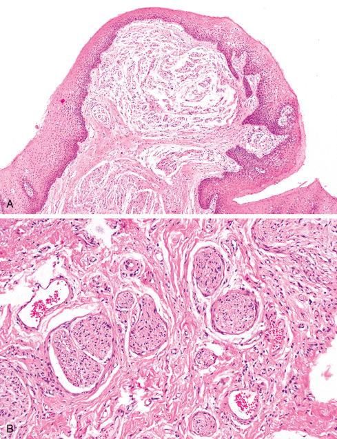 Fig. 26.6, A, Mucosal neuroma from patient with multiple endocrine neoplasia (MEN) type 2b. B, Irregular, convoluted nerves with prominent perineurium and focal myxoid change lie in submucosal tissue.