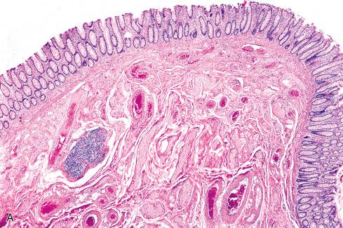 Fig. 26.7, A, Ganglioneuromatosis of gastrointestinal tract in patient with MEN-2b. B, Autonomic nerves in muscle wall are increased in size and number.