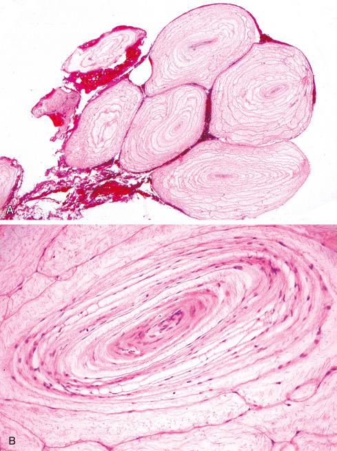 Fig. 26.8, A, Pacinian neuroma. B, High-power view.