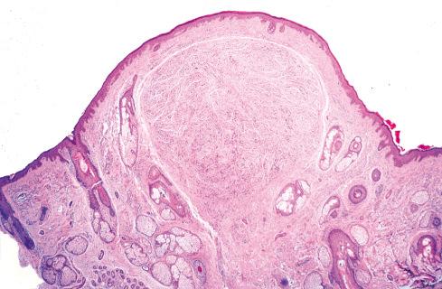 Fig. 26.9, Solitary circumscribed neuroma.