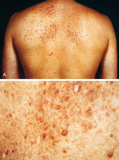 Fig. 15.1, A, Clinical appearance of multiple cutaneous leiomyomas on patient’s back. B, Close-up view.