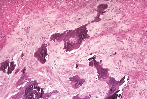 Fig. 15.12, Somatic leiomyoma of soft tissue with calcification.