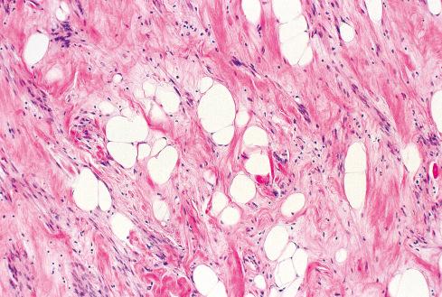 Fig. 15.18, Gynecologic-type leiomyoma with fat (myolipoma)