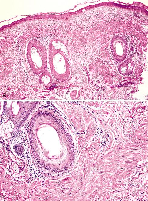 Fig. 15.2, A, Cutaneous leiomyoma of pilar arrector origin. B, Smooth muscle bundles are closely associated with hair follicles and consist of well-differentiated, highly oriented cells.