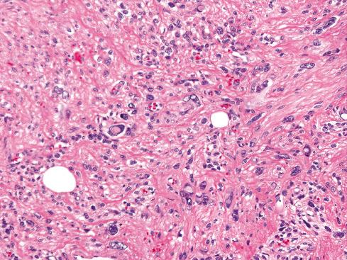 Fig. 15.22, Localized area of atypia within otherwise typical gynecologic-type leiomyoma. Whether these should be regarded as the equivalent to symplastic leiomyomas of uterus is uncertain.