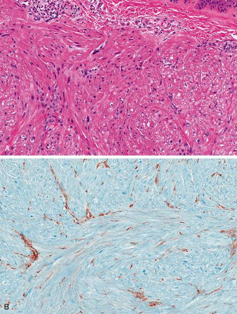 Fig. 15.5, Hereditary leiomyoma associated with fumarate hydratase (FH) deficiency. A, Cells typically show more atypia than classic leiomyomas. B, Immunostain for FH showing loss of enzyme in smooth muscle cells and retention in normal cells.