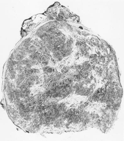 Fig. 15.6, Angiomyoma of Subcutaneous Tissue.