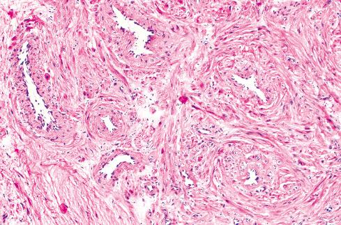 Fig. 15.7, Thick-walled vessel of angiomyoma. Inner layer of muscle is usually arranged circumferentially, and outer layer blends with less well-ordered smooth muscle tissue of tumors.