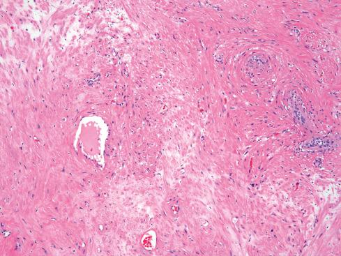 Fig. 15.8, Angiomyoma showing stromal edema between thick-walled vessels.