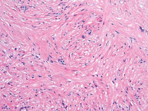 Fig. 15.9, Angiomyoma showing fascicles of mature smooth muscle cells, some with vacuolar change.