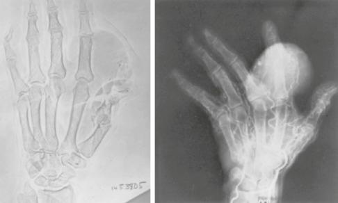 Fig. 15.10, Radiograph showing calcification of soft tissue leiomyoma.