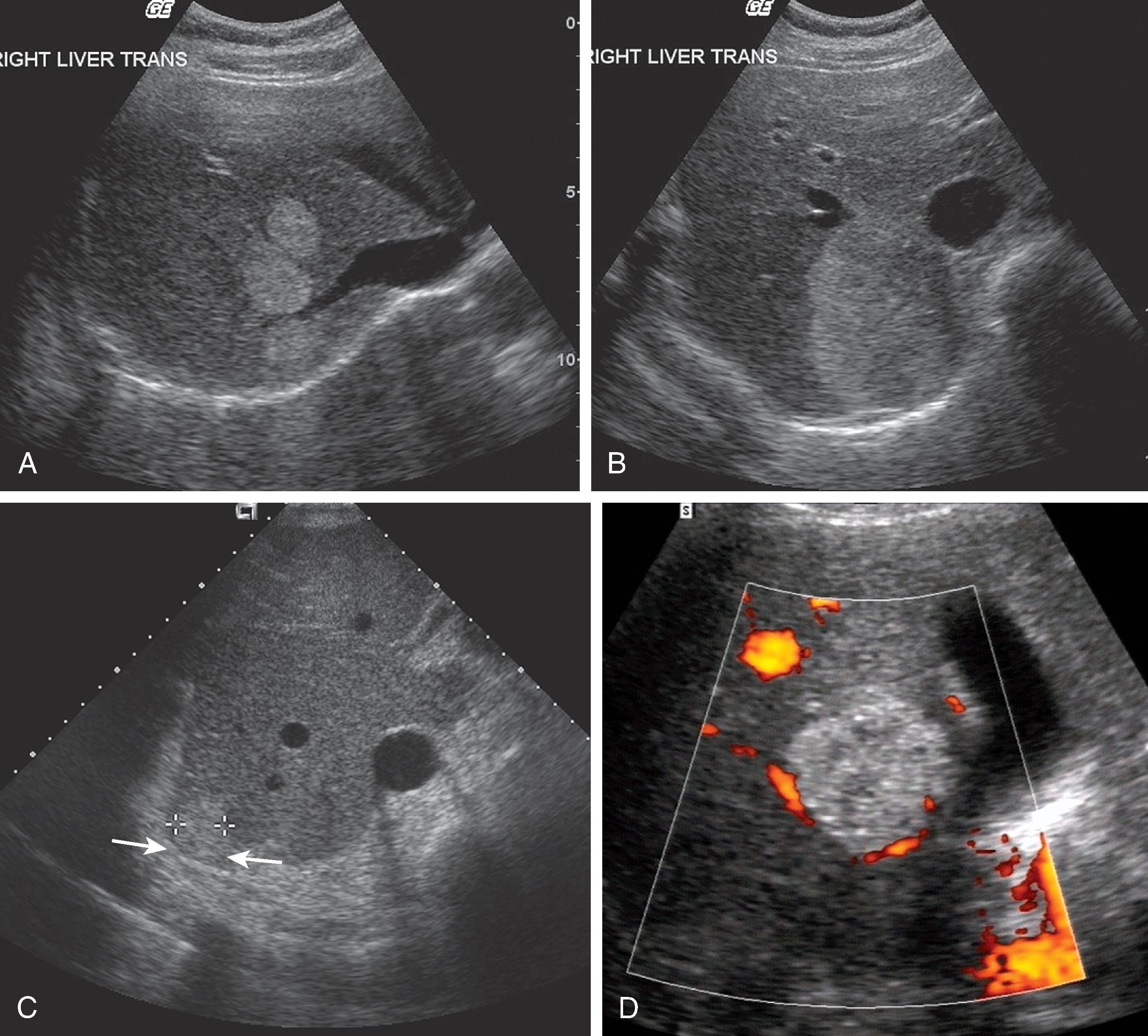 Fig. 53.1, Hemangioma: sonographic findings. (A) Transverse sonogram demonstrates three small, well-marginated, uniformly hyperechoic hemangiomas adjacent to the right hepatic vein. (B) Larger hemangiomas tend to be inhomogeneous because of hemorrhagic necrosis, scarring, and myxomatous change centrally. (C) Acoustic enhancement (arrows) is often seen because of the primarily fluid (blood) component of this echogenic lesion. (D) Despite the vascular nature of this tumor, the blood flow is very slow, so no significant flow is identified on these color Doppler images.