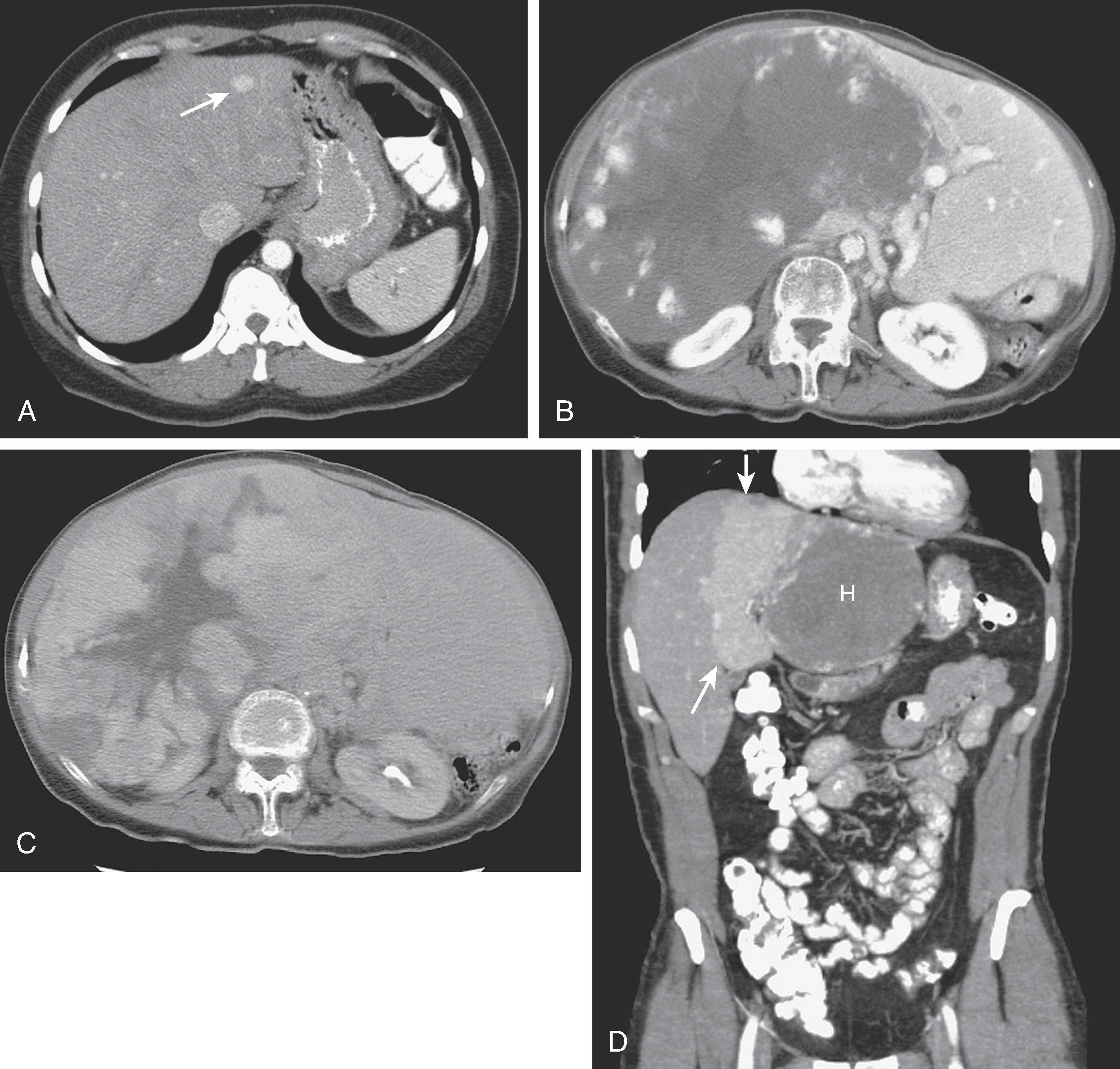 Fig. 53.2, Hepatic hemangioma: computed tomography features. (A) Small hemangiomas (arrow) may demonstrate “flash filling” after intravenous administration of contrast material. The lesion, however, remains isodense with the blood pool, unlike focal nodular hyperplasia, adenoma, hepatoma, and hypervascular metastases, which may also show flash filling. (B and C) Giant hemangioma, which replaces the right lobe, shows peripheral nodular enhancement that progresses in a centripetal fashion. The attenuation of the enhanced portions of the mass is isodense with the blood pool. The central portion of the lesion is a low-attenuation region of central fibrosis. (D) This hemangioma (H) in the lateral segment of the left lobe is causing a transient hepatic attenuation difference (THAD) in the medial segment of the left hepatic lobe (arrows) .