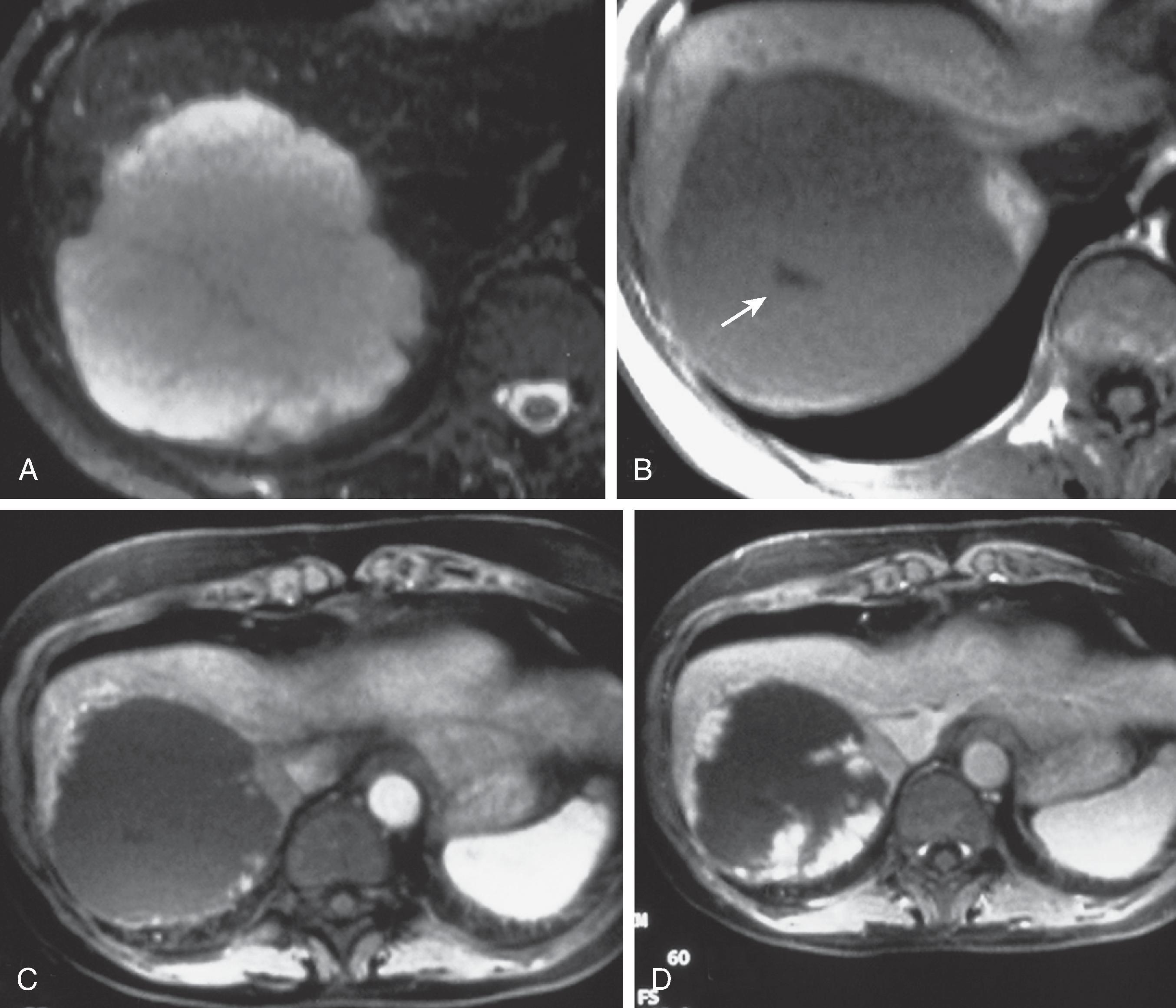 Fig. 53.3, Hepatic hemangioma: magnetic resonance imaging findings. (A) Nonenhanced T2-weighted magnetic resonance image shows a large hyperintense hepatic mass. (B) Nonenhanced T1-weighted image shows low signal intensity. There is a central scar (arrow) that is often seen in large hemangiomas. ( C and D) Gadolinium enhancement demonstrates the characteristic peripheral nodular enhancement pattern that shows centripetal progression.