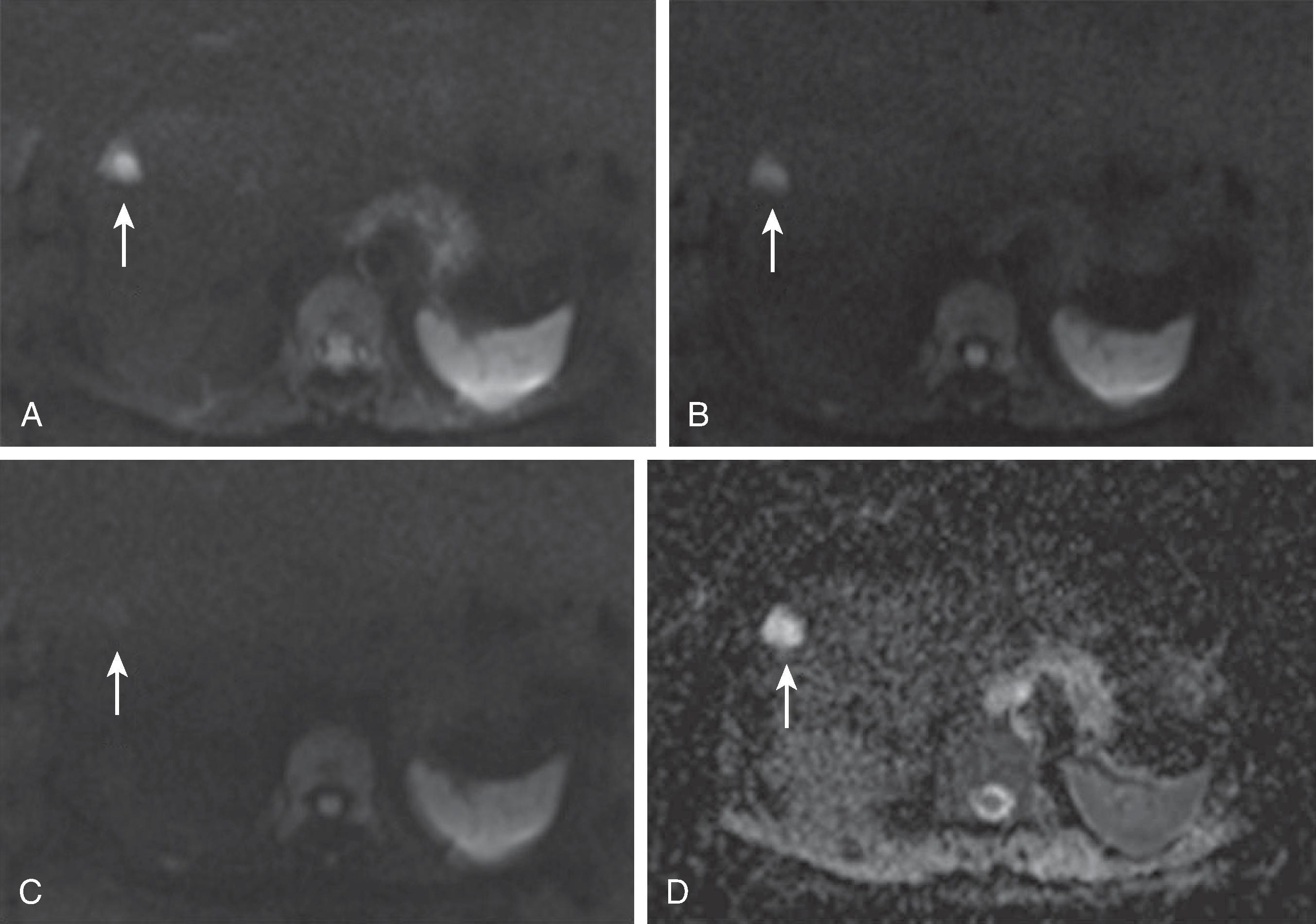 Fig. 53.4, Simple cyst: diffusion-weighted magnetic resonance imaging features with different b values. A simple cyst in the right lobe of the liver (arrow) . The cyst is markedly hyperintense on the diffusion-weighted image with a b value of 50 (A). With increasing b values (B and C, 400 and 800, respectively), the cyst loses signal intensity. It has a high apparent diffusion coefficient value (D).