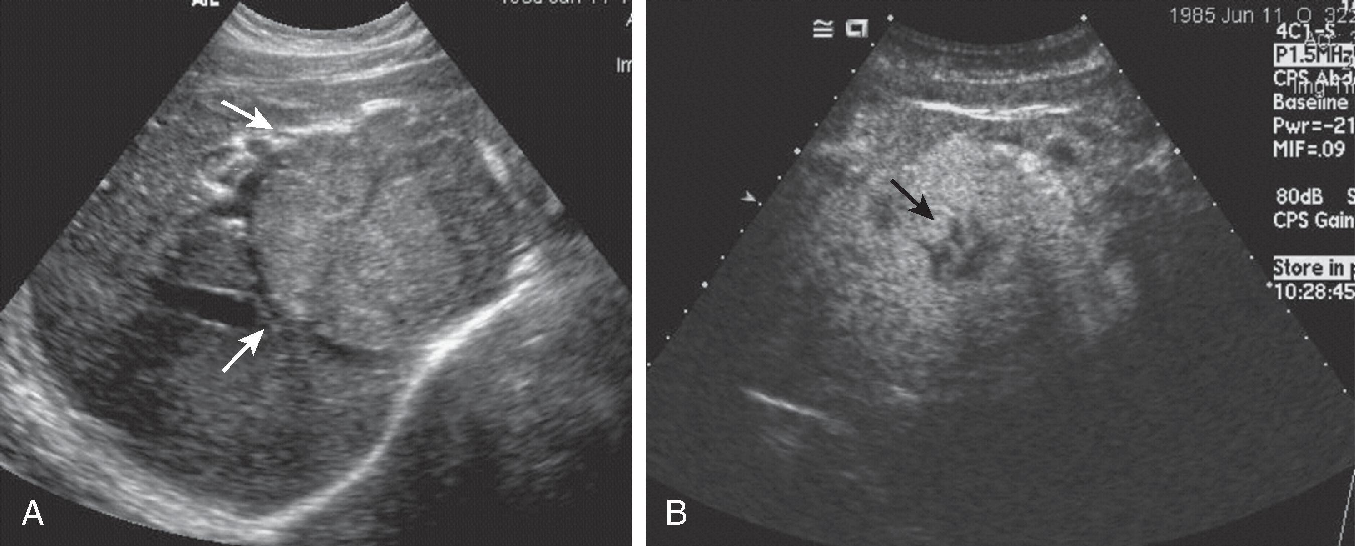 Fig. 53.5, Focal nodular hyperplasia (FNH): ultrasound findings. (A) Sonogram demonstrates a large lesion in the right lobe of the liver (arrows) . (B) Contrast-enhanced sonogram demonstrates early arterial enhancement of FNH; note that central scar shows no enhancement (arrow) .