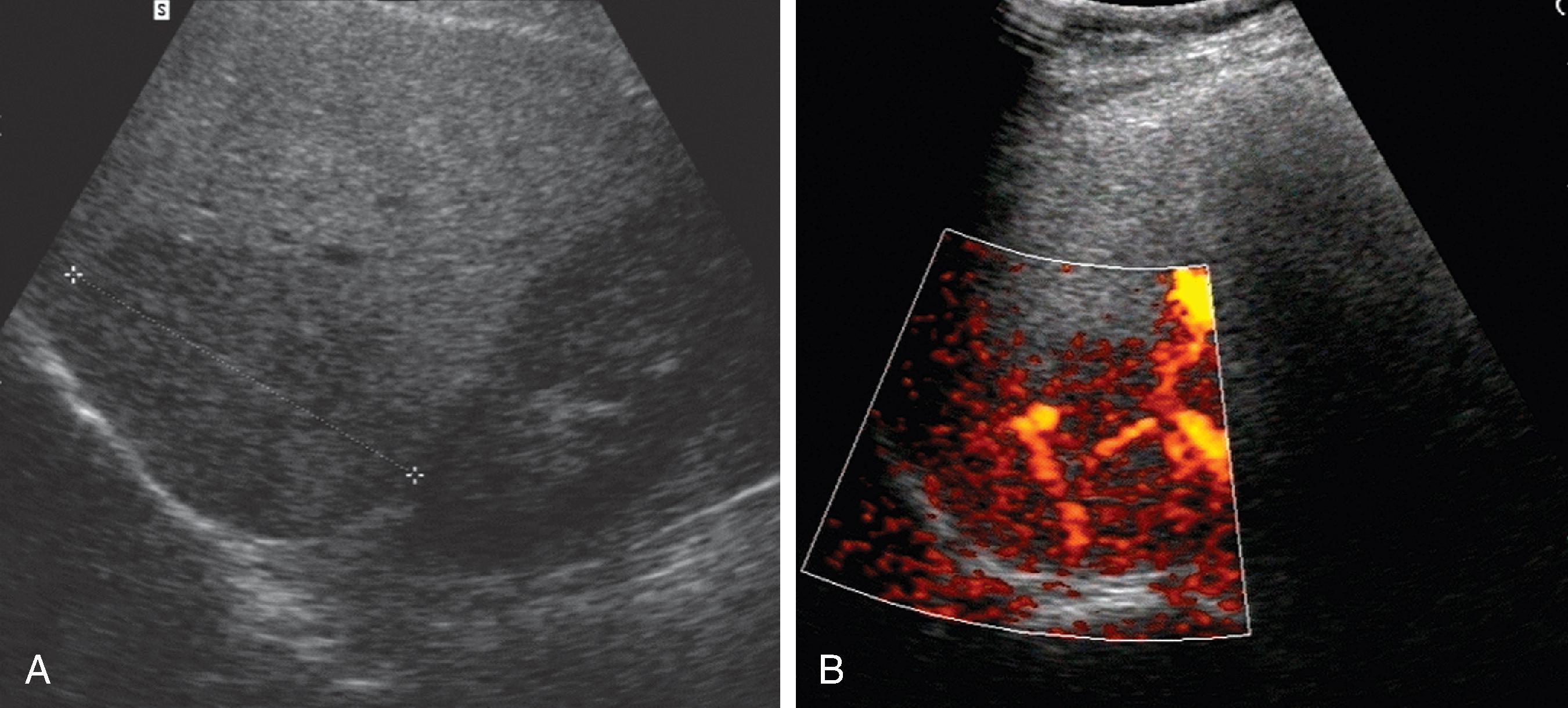 Fig. 53.6, Focal nodular hyperplasia: color Doppler ultrasound. (A) There is a large hypoechoic mass in the right lobe of the liver. (B) It is quite vascular on color Doppler imaging.