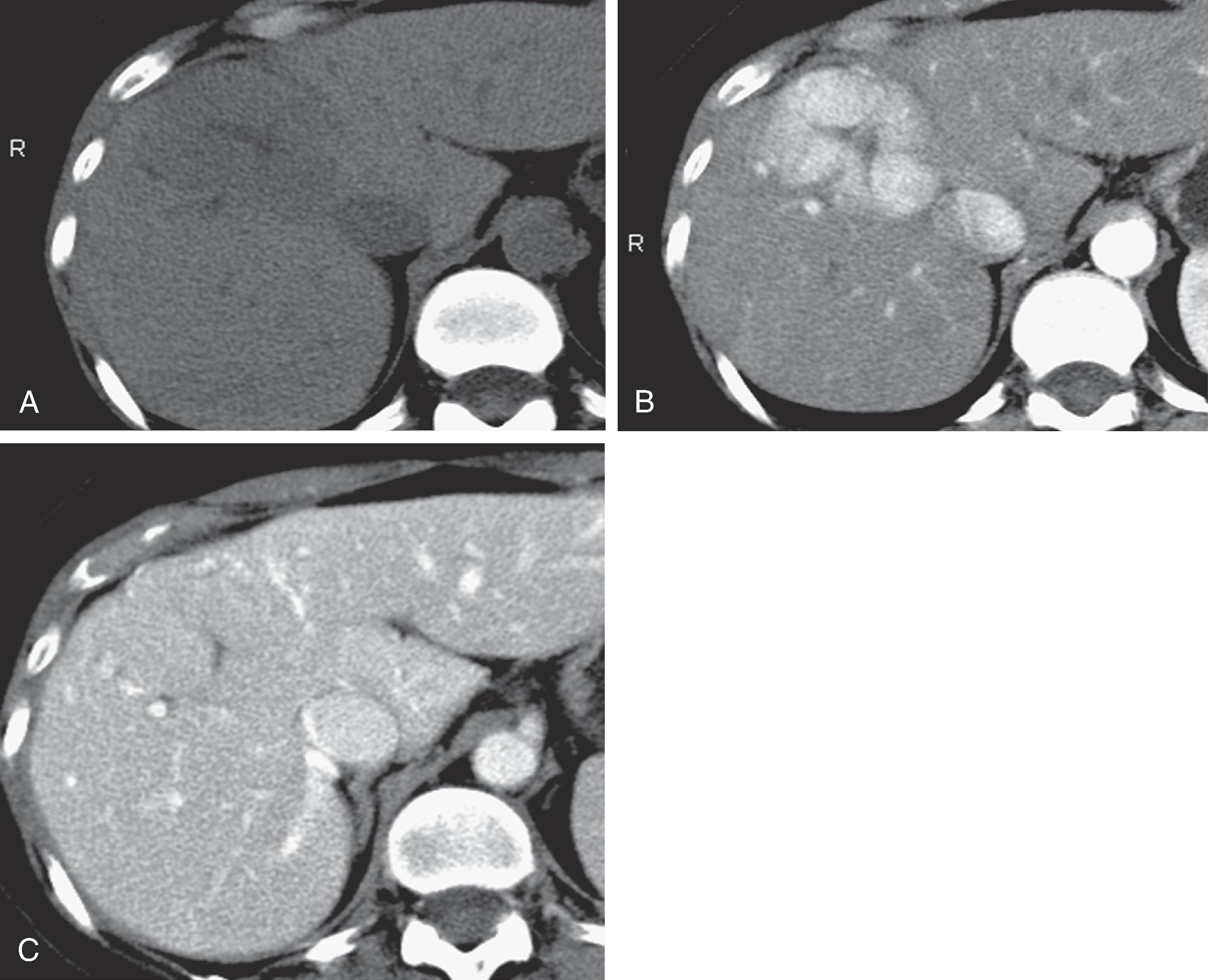 Fig. 53.7, Focal nodular hyperplasia (FNH): computed tomography features. (A) On noncontrast scans, FNH is usually isodense with normal liver. Note the central scar. (B) This lesion shows striking enhancement during the arterial phase with the exception of the scar. (C) The lesion rapidly becomes isodense with normal liver.