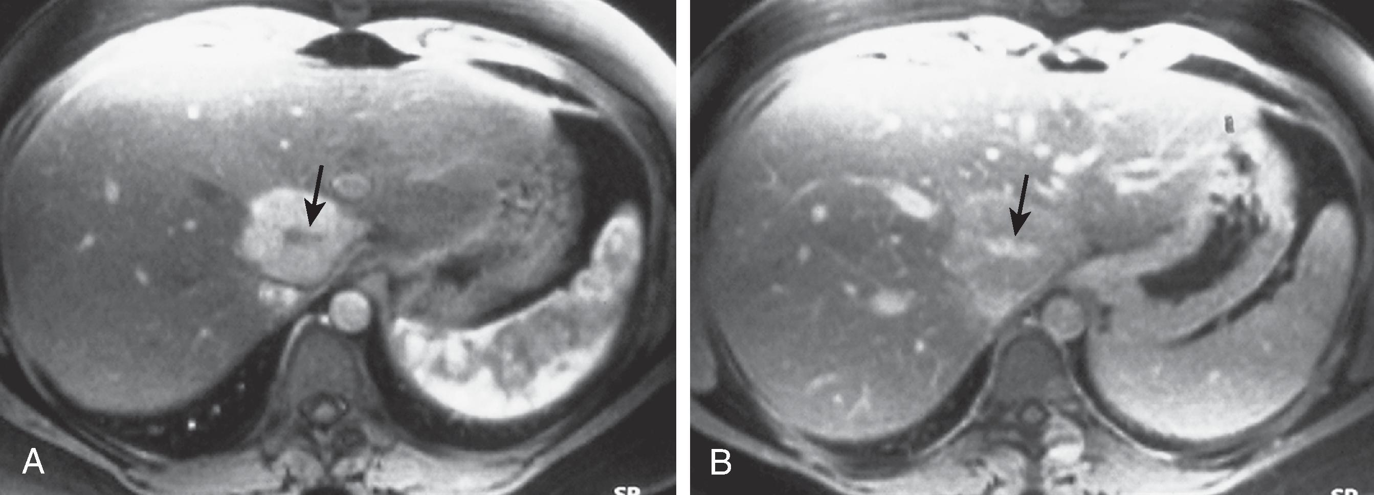 Fig. 53.9, Focal nodular hyperplasia: magnetic resonance imaging features. (A) During the arterial phase of enhancement, the lesion shows robust enhancement with the exception of the central scar (arrow) . (B) The mass rapidly de-enhances, and there is enhancement of the central scar (arrow) .