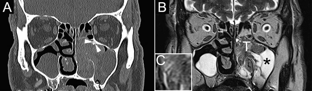 Fig. 50.3, Inverted papilloma of the left nasal fossa on a computed tomography (CT) scan and magnetic resonance (MR) image.