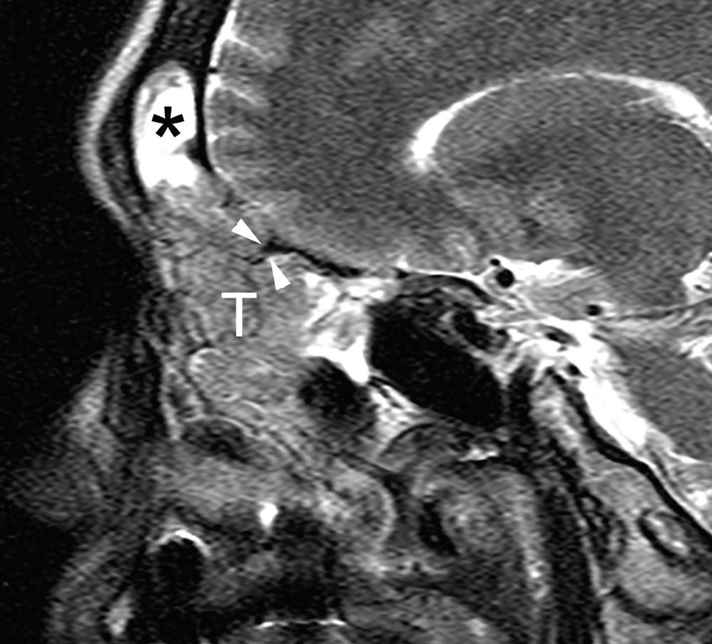 Fig. 50.5, Inverted papilloma on a sagittal T2-weighted magnetic resonance image.