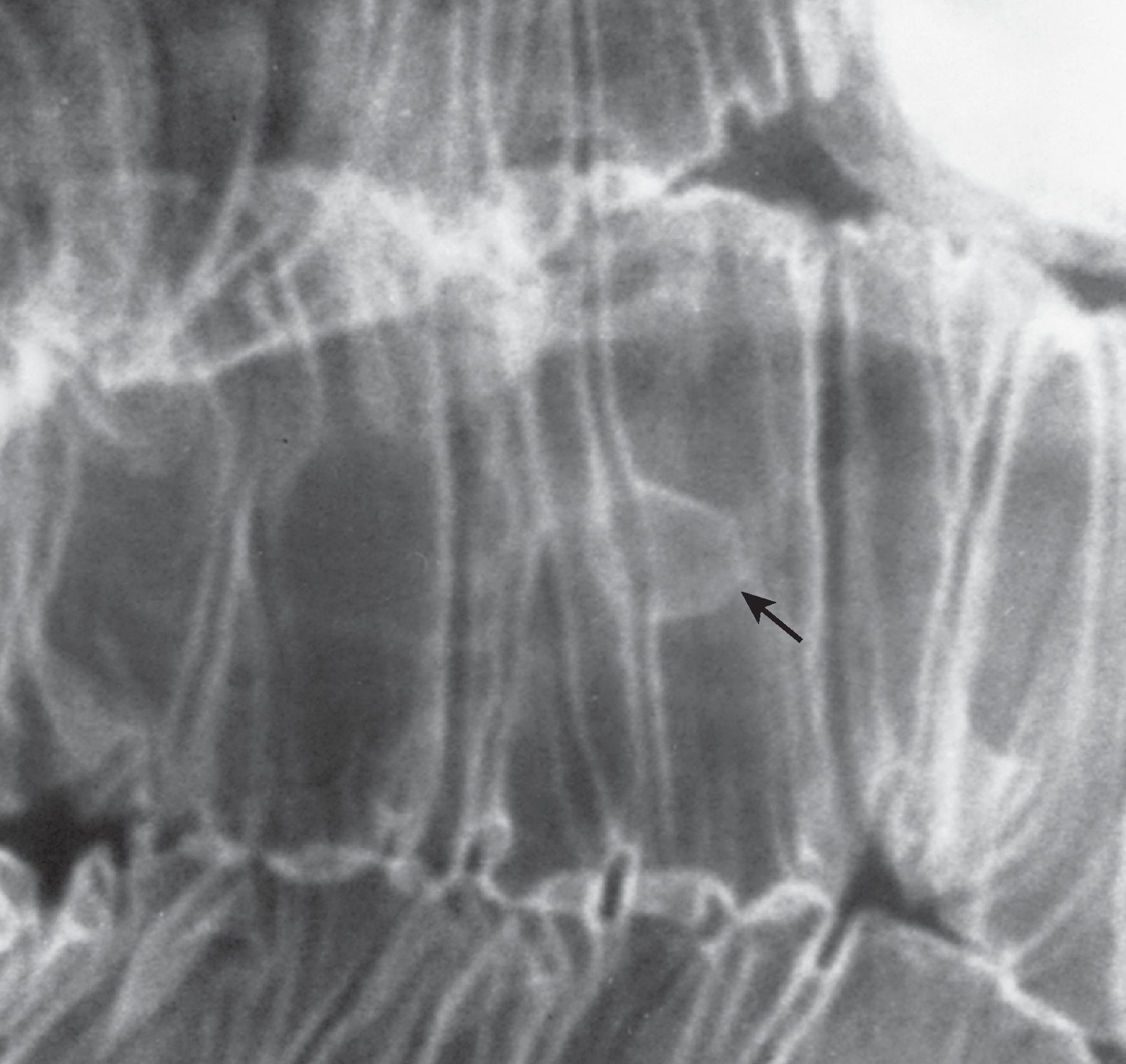 Fig. 30.1, Adenoma.