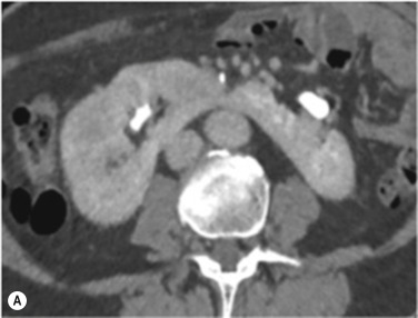 Fig. 28.1, Horseshoe Kidney on Contrast-Enhanced Computed Tomography (CECT).