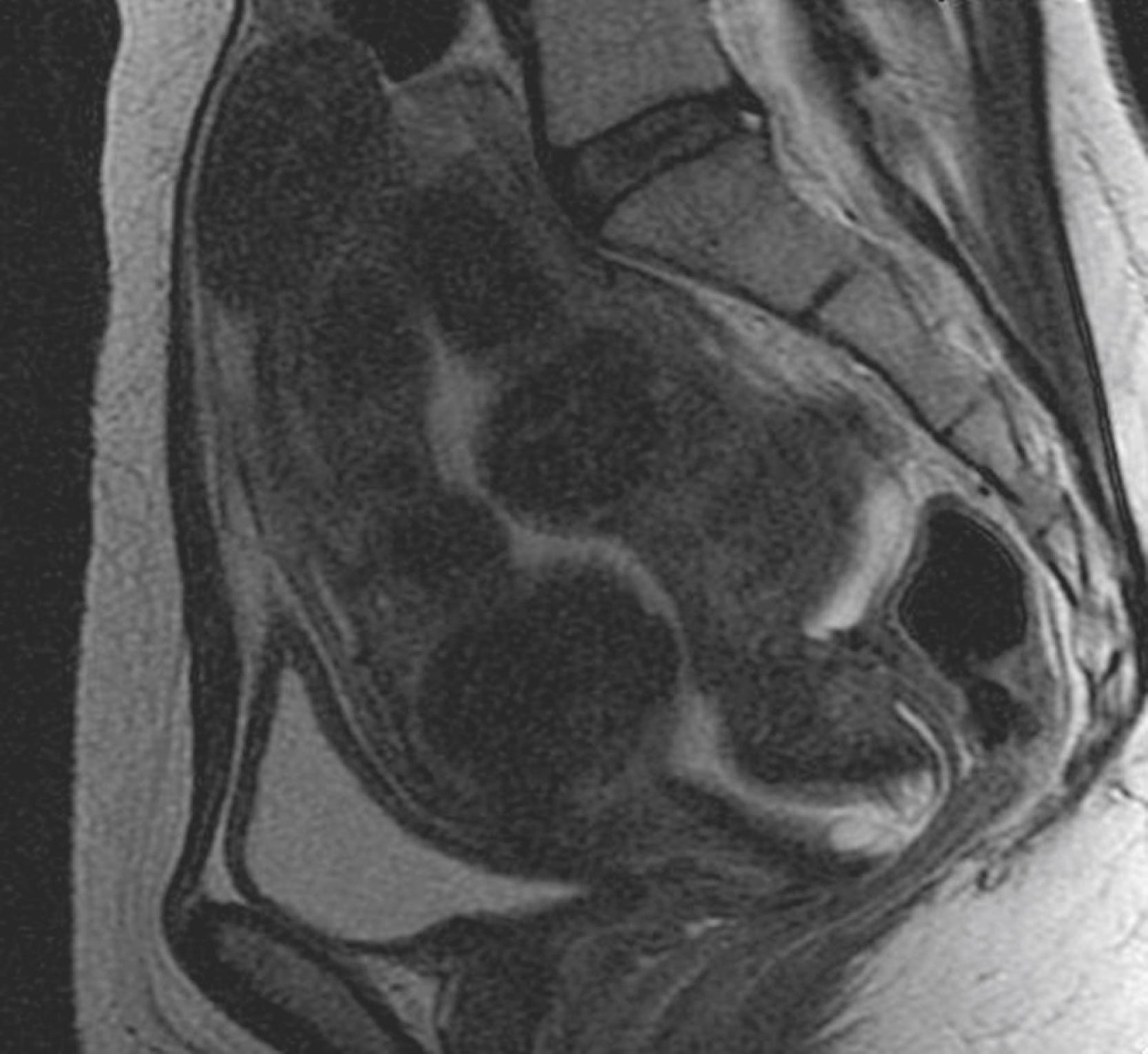 Fig. 26.2, A T2-weighted fast-spin echo (FSE) sagittal image of a leiomyomatous uterus with multiple type II submucosal fibroids.