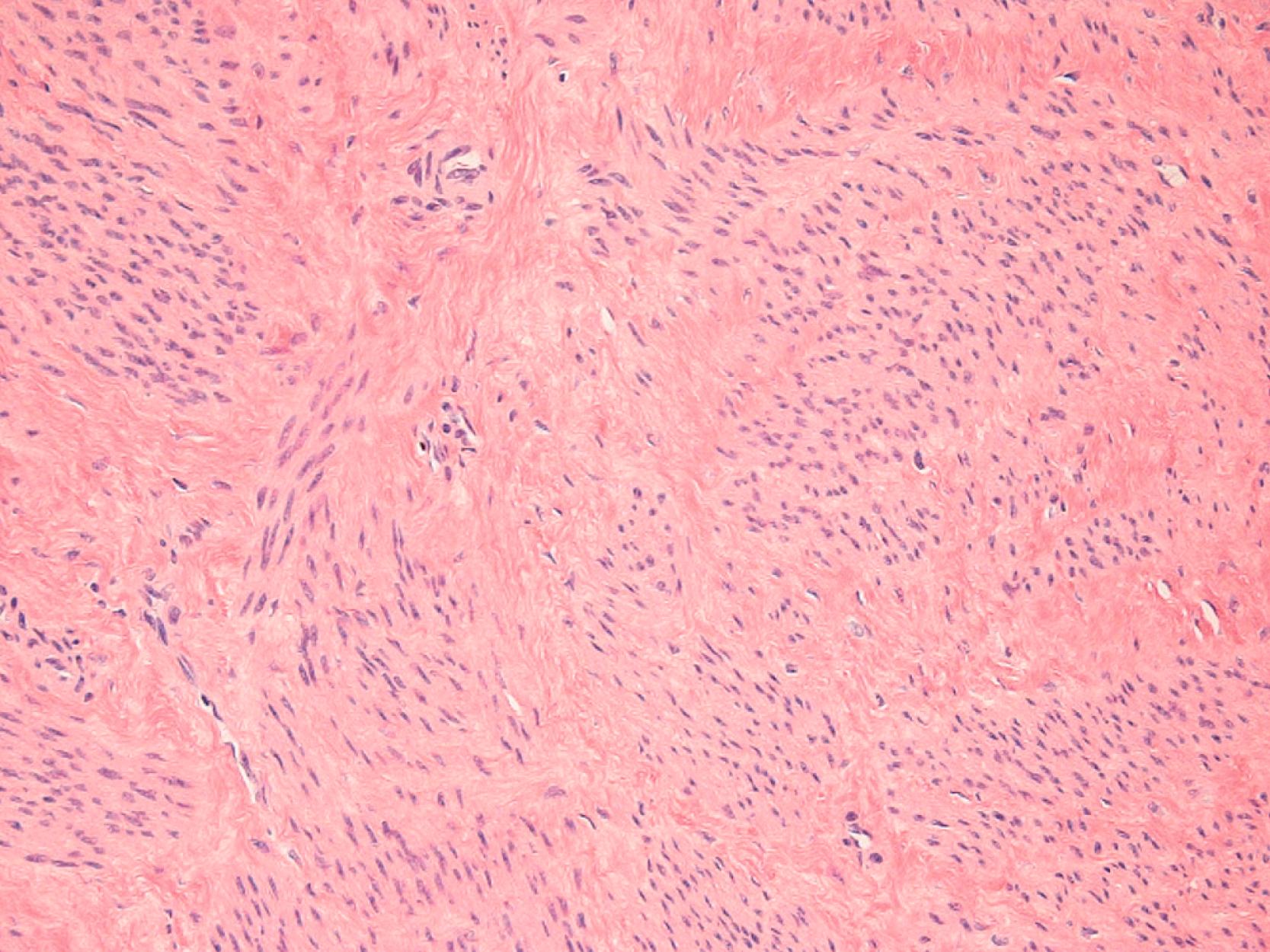 Fig. 26.3, Histological evaluation of fibroid using hematoxylin and eosin staining highlights both cellular bundles and the acellular extracellular matrix.