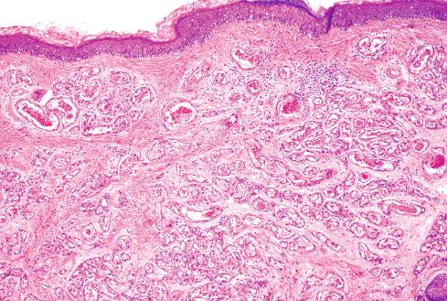 Fig. 20.1, Adult form of capillary hemangioma consisting of small vessels lined by flattened mature endothelium.