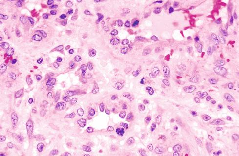 Fig. 20.12, Mitotic activity in stromal and endothelial cells as reactive change in pyogenic granuloma.