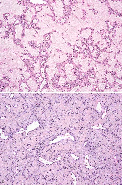 Fig. 20.13, Intranasal pyogenic granuloma, showing extensive myxoid change ( A ) and stromal hyalinization ( B ). These changes may obscure the underlying lobular growth pattern of pyogenic granuloma and result in confusion with other highly vascular sinonasal tumors, such as glomangiopericytoma and nasopharyngeal angiofibroma.