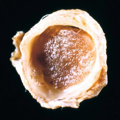 Fig. 20.14, Gross specimen of intravascular form of pyogenic granuloma.