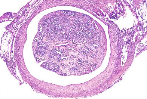 Fig. 20.15, Intravascular pyogenic granuloma with preservation of the lobular arrangement of vessels.