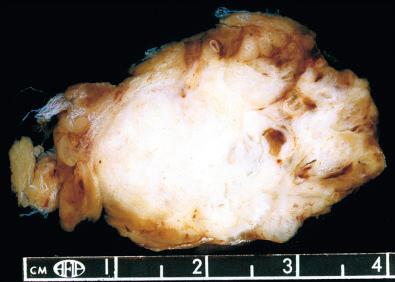 Fig. 20.16, Gross appearance of intramuscular hemangioma involving the medial thigh. Lesions often have a solid, nonhemorrhagic appearance.