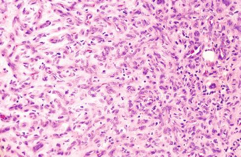 Fig. 20.18, Small vessel (capillary) type of intramuscular hemangioma.